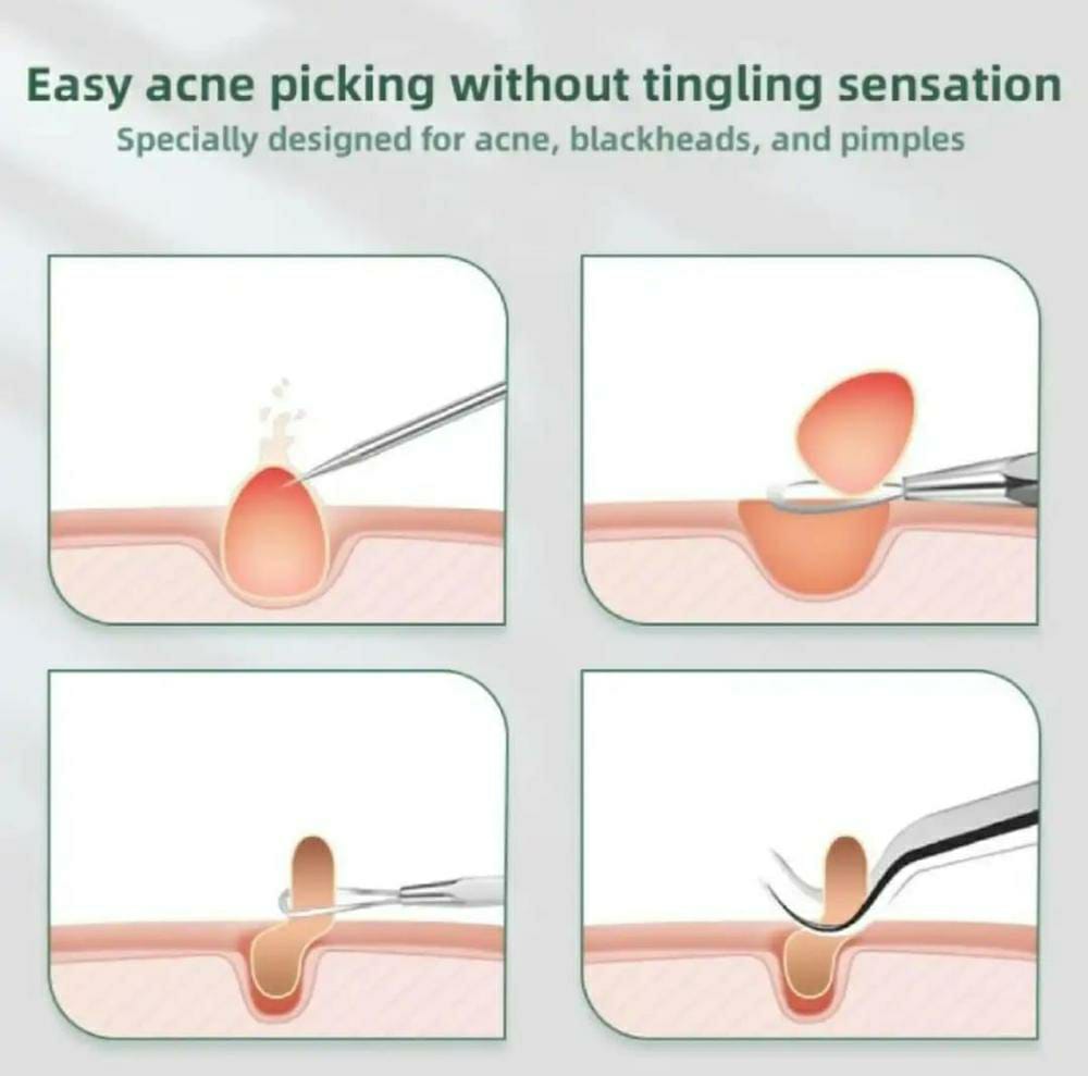 8 Pcs White and Blackhead Remover Tools
